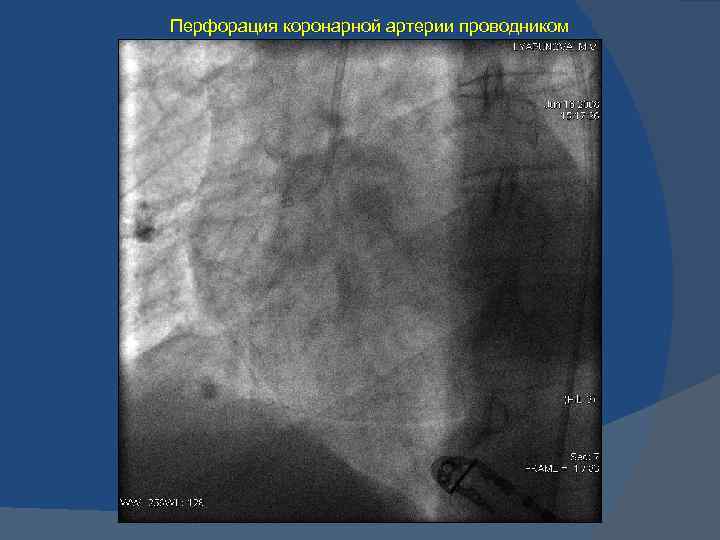 Перфорация коронарной артерии проводником 