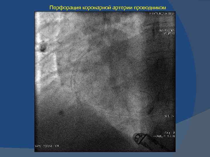 Реканализация вен нижних. Классификация перфораций коронарных артерий. Реканализация коронарных артерий. Перфорация коронарной артерии по Ellis.