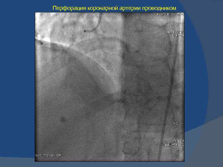 Перфорация коронарной артерии проводником 