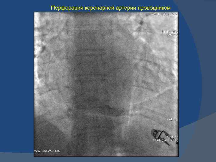 Перфорация коронарной артерии проводником 