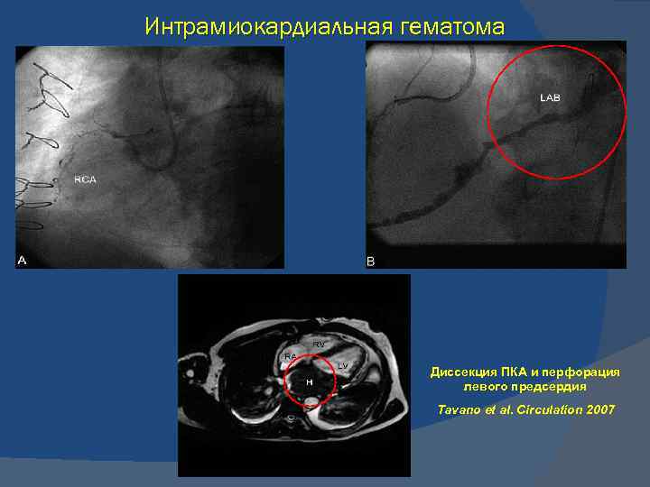 Интрамиокардиальная гематома Диссекция ПКА и перфорация левого предсердия Tavano et al. Circulation 2007 