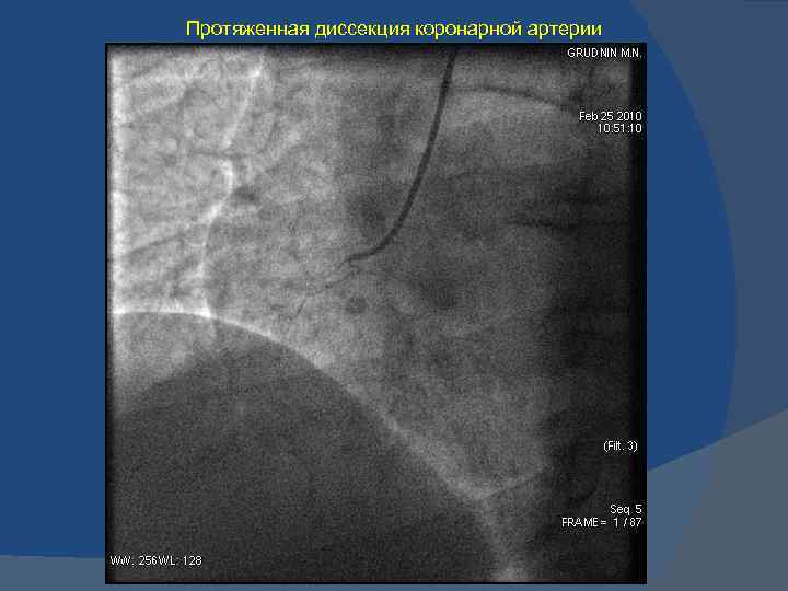 Протяженная диссекция коронарной артерии 