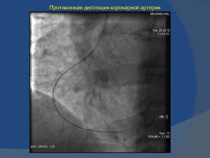 Протяженная диссекция коронарной артерии 