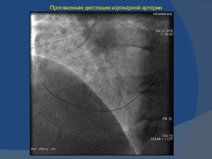 Протяженная диссекция коронарной артерии 
