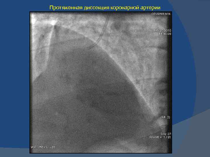 Протяженная диссекция коронарной артерии 