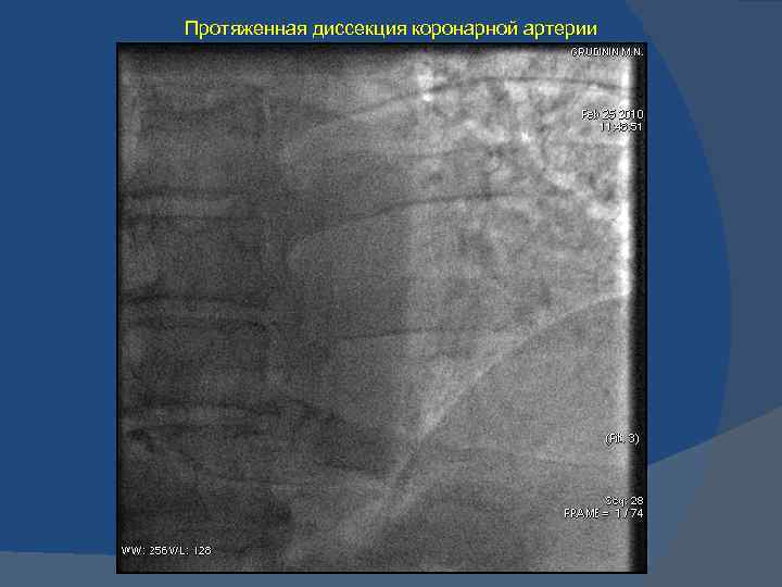 Протяженная диссекция коронарной артерии 