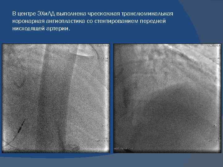 В центре ЭХи. ЛД выполнена чрескожная транслюминальная коронарная ангиопластика со стентированием передней нисходящей артерии.