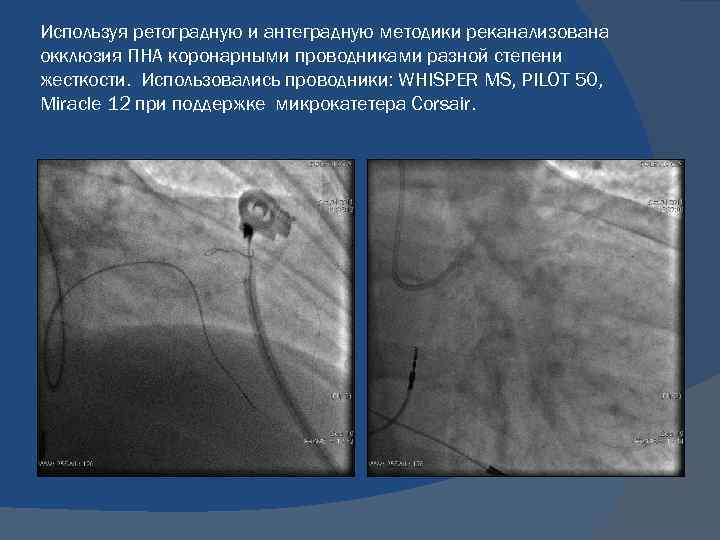 Коронарная окклюзия. Коронарография окклюзия ПКА. Коронарография стеноз ПНА. Хроническая окклюзия коронарных.