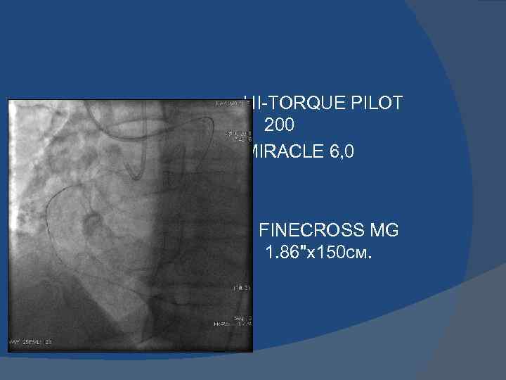 HI-TORQUE PILOT 200 MIRACLE 6, 0 FINECROSS MG 1. 86"х150 см. 