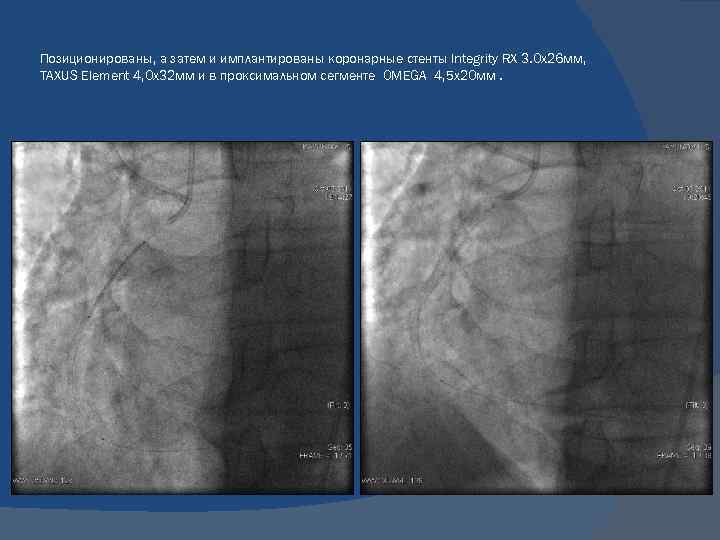 Позиционированы, а затем и имплантированы коронарные стенты Integrity RX 3. 0 х26 мм, TAXUS
