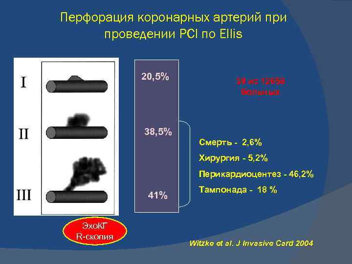 Перфорация коронарных артерий при проведении PCI по Ellis 20, 5% 39 из 12658 больных