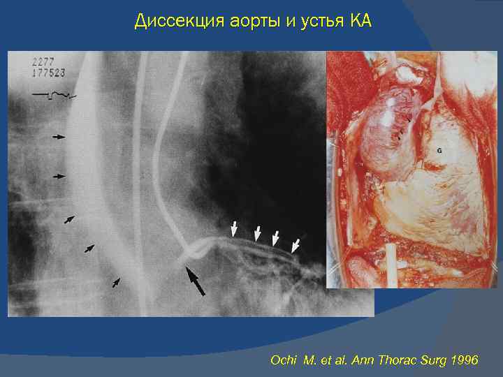 Диссекция аорты и устья КА Ochi M. et al. Ann Thorac Surg 1996 