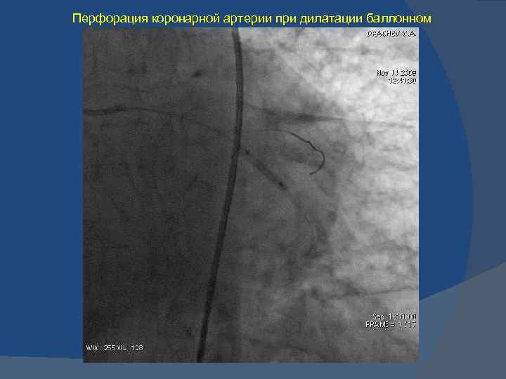 Перфорация коронарной артерии при дилатации баллонном 