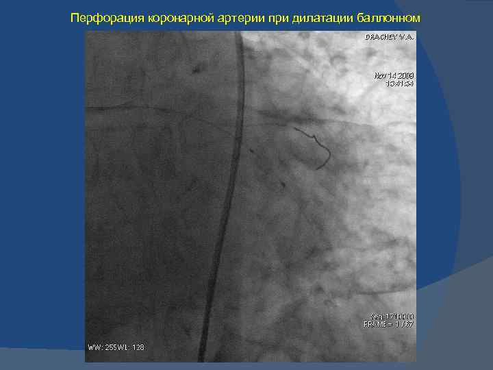 Перфорация коронарной артерии при дилатации баллонном 