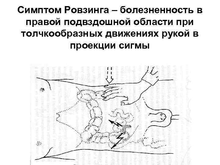 Симптом Ровзинга – болезненность в правой подвздошной области при толчкообразных движениях рукой в проекции