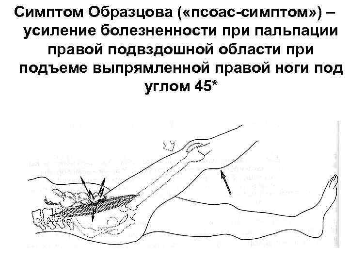 Симптом Образцова ( «псоас-симптом» ) – усиление болезненности при пальпации правой подвздошной области при
