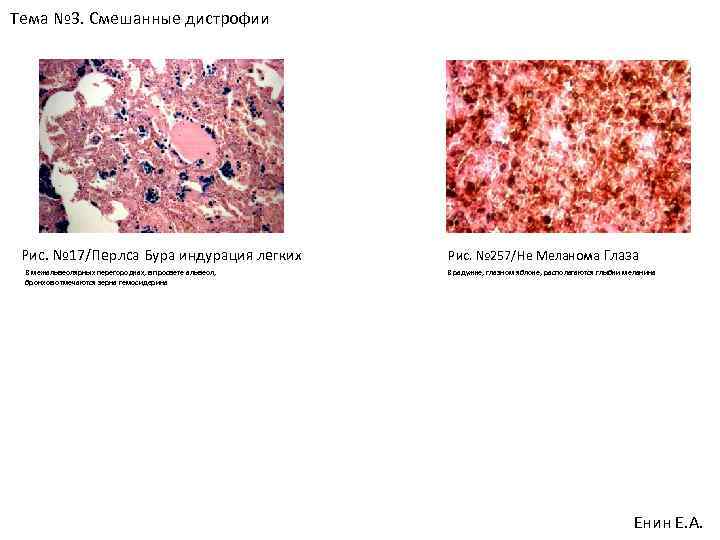 Тема № 3. Смешанные дистрофии Рис. № 17/Перлса Бура индурация легких В межальвеолярных перегородках,