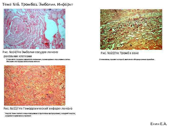 Тема № 6. Тромбоз. Эмболия. Инфаркт Рис. № 14/Не Эмболия сосудов легкого раковыми клетками