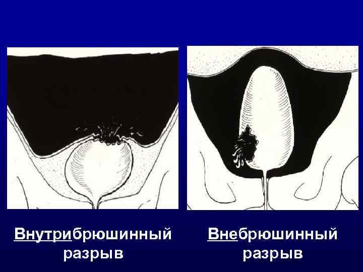 Внутрибрюшинный разрыв Внебрюшинный разрыв 