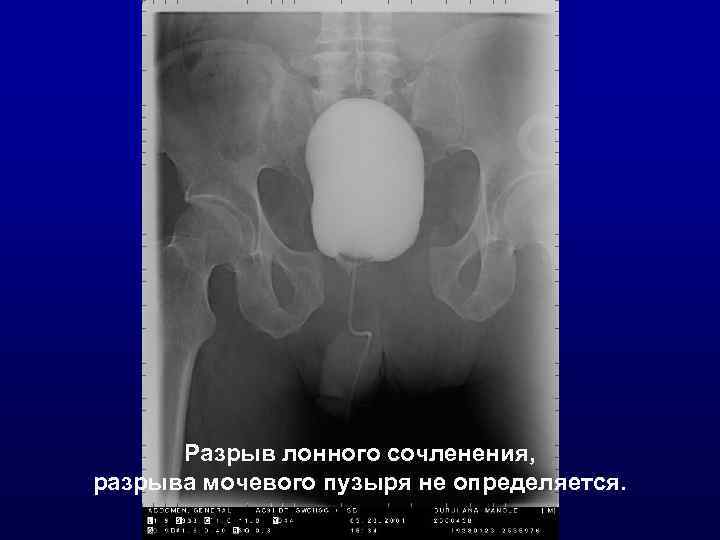 Разрыв лонного сочленения, разрыва мочевого пузыря не определяется. 