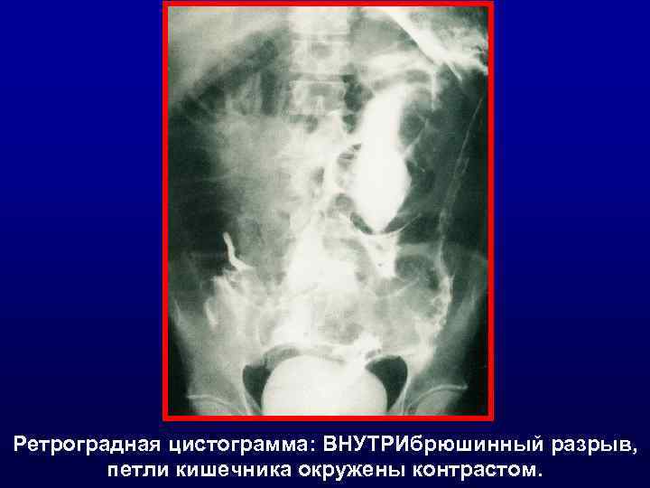 Ретроградная цистограмма: ВНУТРИбрюшинный разрыв, петли кишечника окружены контрастом. 