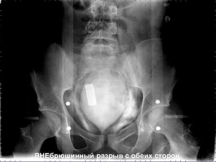 ВНЕбрюшинный разрыв с обеих сторон. 
