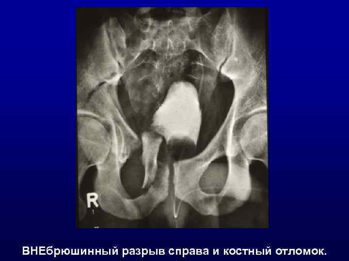 ВНЕбрюшинный разрыв справа и костный отломок. 