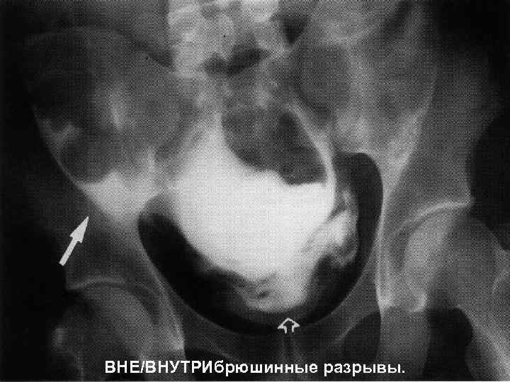 ВНЕ/ВНУТРИбрюшинные разрывы. 