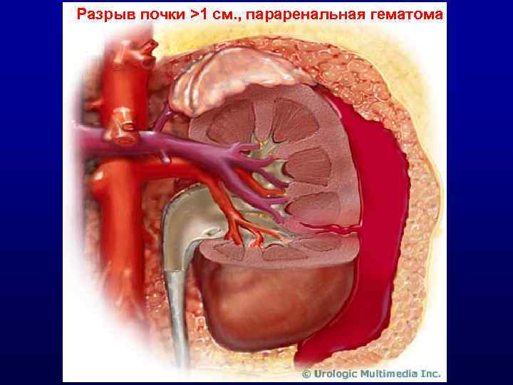 Разрыв почки >1 см. , параренальная гематома 