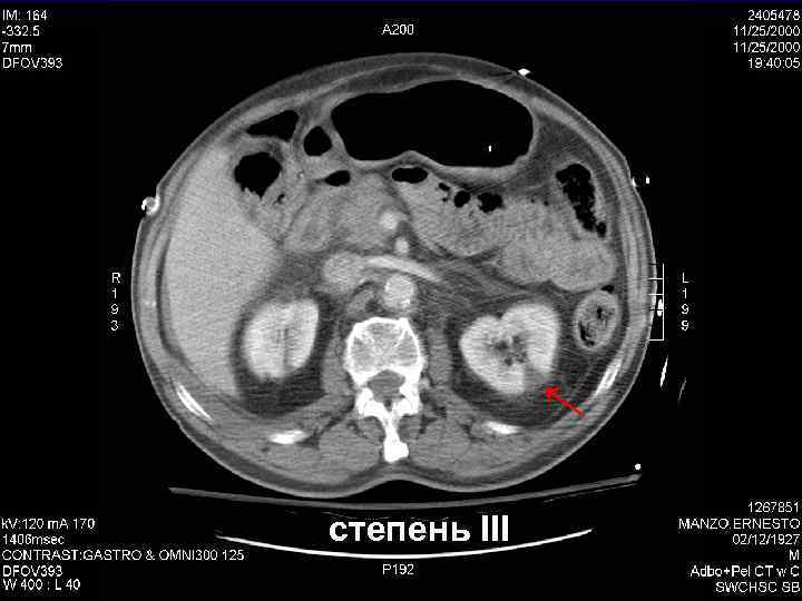 ↑ степень III 