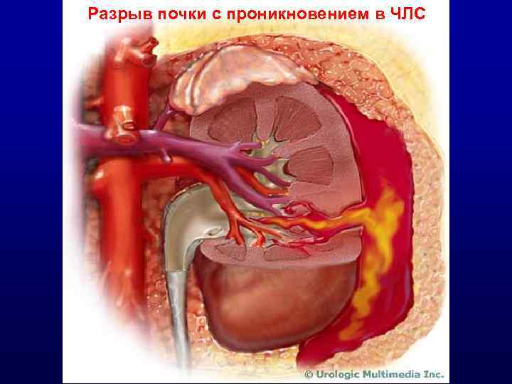 Разрыв почки с проникновением в ЧЛС 