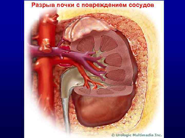 Разрыв почки с повреждением сосудов 