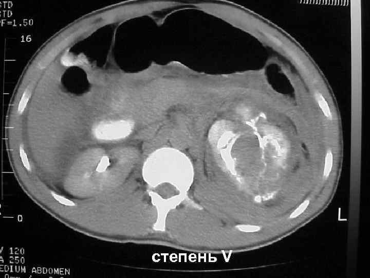 степень V 