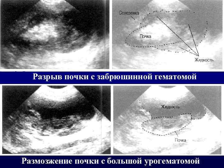 Разрыв почки с забрюшинной гематомой Размозжение почки с большой урогематомой 
