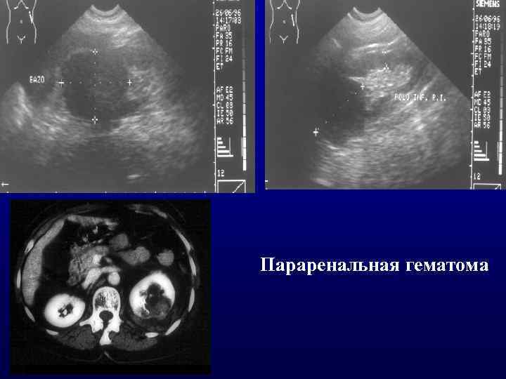Параренальная гематома 
