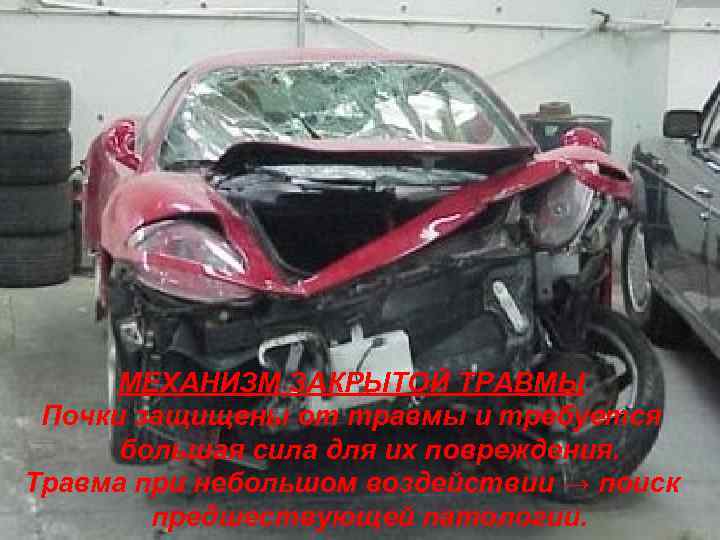 МЕХАНИЗМ ЗАКРЫТОЙ ТРАВМЫ Почки защищены от травмы и требуется большая сила для их повреждения.