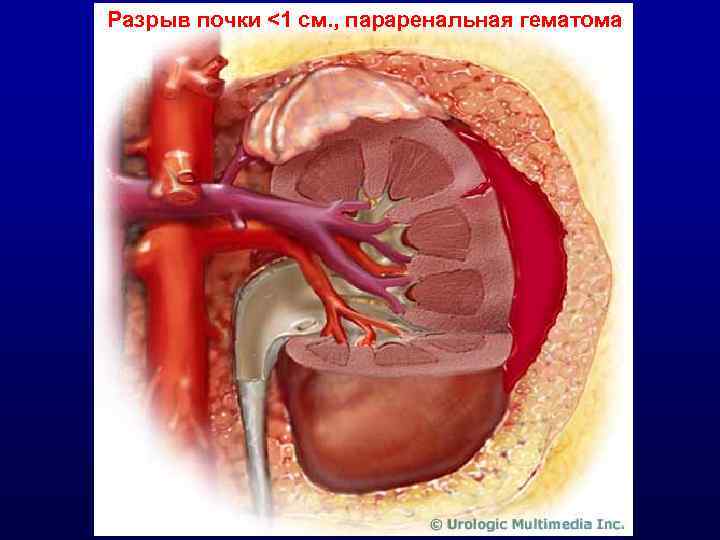 Разрыв почки <1 см. , параренальная гематома 