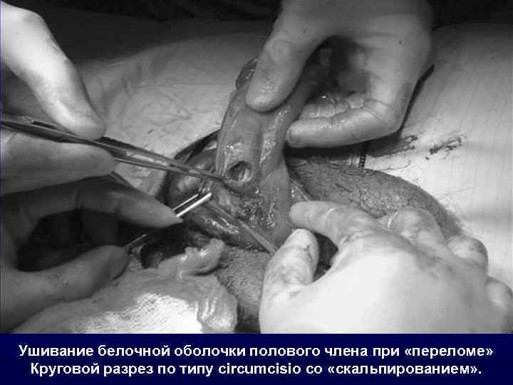 Ушивание белочной оболочки полового члена при «переломе» Круговой разрез по типу circumcisio со «скальпированием»