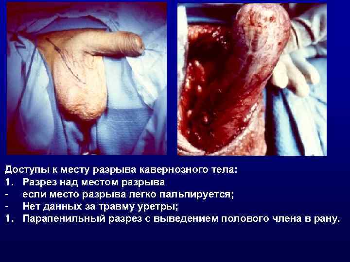 Доступы к месту разрыва кавернозного тела: 1. Разрез над местом разрыва - если место