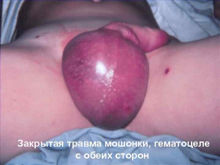 Закрытая травма мошонки, гематоцеле с обеих сторон 