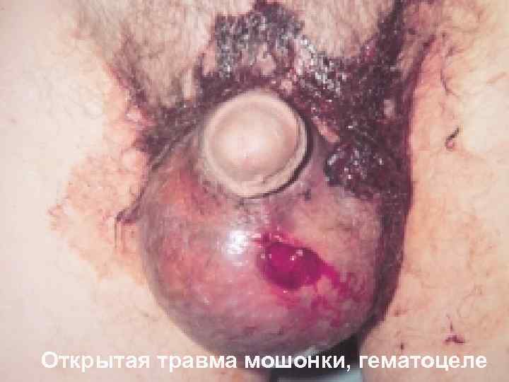 Открытая травма мошонки, гематоцеле 