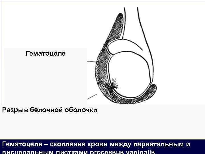 Гематоцеле Разрыв белочной оболочки Гематоцеле – скопление крови между париетальным и 