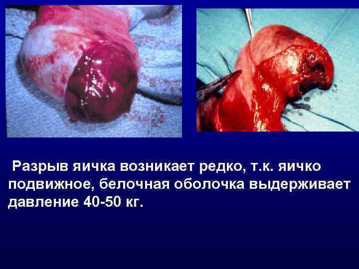 Разрыв яичка возникает редко, т. к. яичко подвижное, белочная оболочка выдерживает давление 40 -50