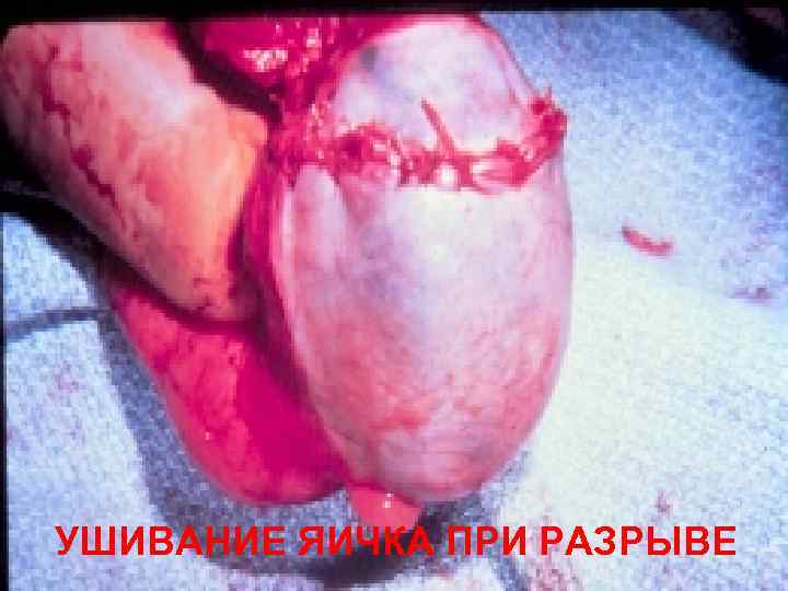 УШИВАНИЕ ЯИЧКА ПРИ РАЗРЫВЕ 