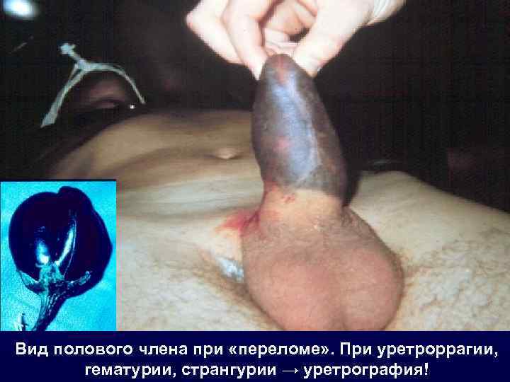 Вид полового члена при «переломе» . При уретроррагии, гематурии, странгурии → уретрография! 