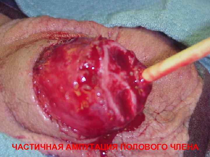 ЧАСТИЧНАЯ АМПУТАЦИЯ ПОЛОВОГО ЧЛЕНА 