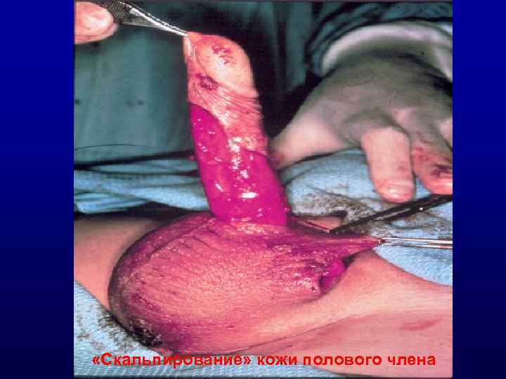  «Скальпирование» кожи полового члена 