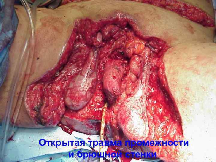 Открытая травма промежности и брюшной стенки 