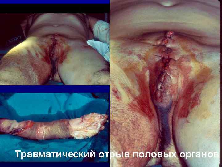 Травматический отрыв половых органов 