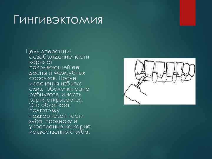 Гингивэктомия Цель операции освобождение части корня от покрывающей ее десны и межзубных сосочков. После